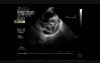 Infective Endocarditis On Mitral Stenosis 2