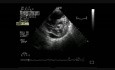 Infective Endocarditis On Mitral Stenosis 2