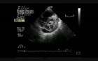 Infective Endocarditis On Mitral Stenosis 2