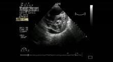 Infective Endocarditis On Mitral Stenosis 2