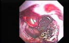 Hemorrhage After Ligation - Searching For the Site of Bleeding