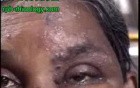 Herpes Zoser Of V1