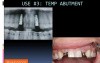 The Iconic 3-In-1 Biohorizons Abutment