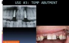 The Iconic 3-In-1 Biohorizons Abutment