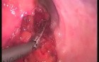 Rectopexy - SILS 