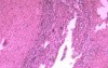 Multiple Rectal Ulcers (110 of 110)