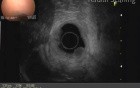 Endoscopic resection of duodenal tumor