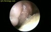 Rhinosporidiosis 