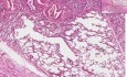 Pleura - Adhesion