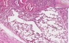 Pleura - Adhesion