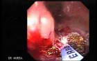 Cap polyposis that resemble a adenocarcinoma of the rectum (5 of 7)