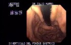 Gastric Fundus Diverticulum