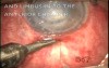 Microtrack filtration to the anterior chamber