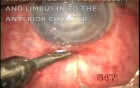 Microtrack filtration to the anterior chamber