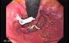Longstanding gastroesophageal reflux disease (1 of 7)