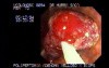 Video Colonoscopic view of a polypectomy of a big 6 cm. x 4 cm. sessile lesion (2 of 4)