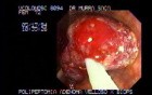 Video Colonoscopic view of a polypectomy of a big 6 cm. x 4 cm. sessile lesion (2 of 4)