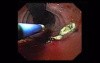 Mallory-Weiss Syndrome - Hemostatic Therapy with Argon Plasma Coagulator, Part 2