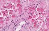 Adenocarcinoma (linitis plastica)