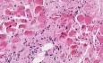 Adenocarcinoma (linitis plastica)