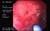 Radiation Proctosigmoiditis (4 of 14)
