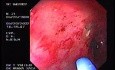 Radiation Proctosigmoiditis (4 of 14)