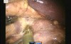 Robotic Left Adrenalectomy