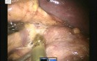 Robotic Left Adrenalectomy