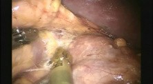 Robotic Left Adrenalectomy