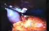 Jejunal Gastrointestinal Stromal tumor (GIST) (83 of 86)