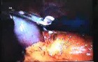 Jejunal Gastrointestinal Stromal tumor (GIST) (83 of 86)