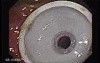 Percutaneous Endoscopic Gastrostomy - PEG (5 of 6)