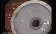 Percutaneous Endoscopic Gastrostomy - PEG (5 of 6)