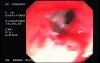 Recto-vaginal Fistula (2 of 3)