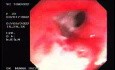 Recto-vaginal Fistula (2 of 3)