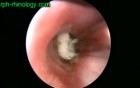 Bronchoscopy In A 15 Months Old Child
