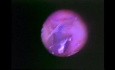Functional Endoscopic Sinus Surgery - Anatomical Demostration - Part 3 of 5