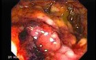 Toxic Dilatation Of The Colon Superimposed Pseudomembranous Colitis (10 z 17)