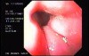 Banding of Esophageal Varices - Five Days Follow Up