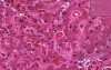 Liver - Hemochromatosis