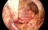 Totally transumbilical laparoscopic hernioplasty bilateral
