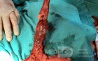 Barrett Adenocarcinoma - Endoscopic Image (15 of 20)