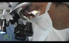 Rhinoplasty - Before And After The Nose Surgery