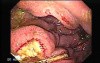 Presence of Multiple Irregular and Large Ulcers - 44 Years-Old Male