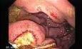 Presence of Multiple Irregular and Large Ulcers - 44 Years-Old Male