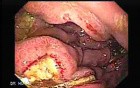 Presence of Multiple Irregular and Large Ulcers - 44 Years-Old Male