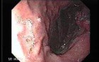 Gastric Adenocarcinoma With Varices - Endoscopy (2 of 8)