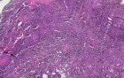 Alveolar rhabdomyosarcoma - Histopathology of skeletal muscle, face