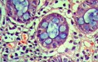 Barrett's Esophagus of long segment (23 of 24)