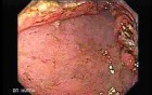 Adenocarcinoma of the Antrum (2 of 5)